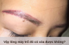 Vậy lông mày trổ đỏ có xóa được không?