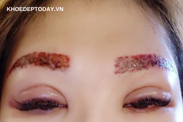 Một vài lưu ý khi xóa xăm lông mày bằng laser