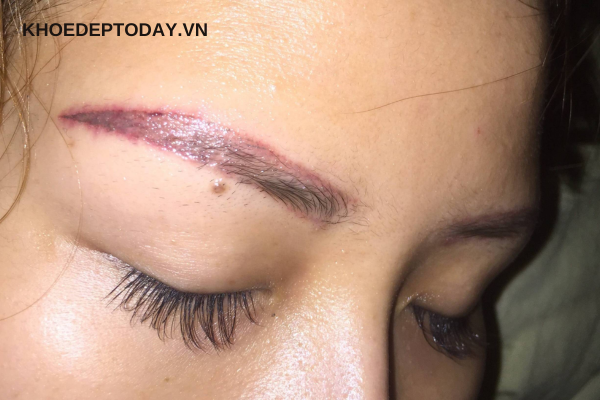 Những bước xóa xăm lông mày bằng laser