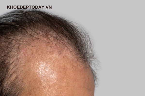 Rụng tóc ở nam giới có liên quan đến bệnh lý nào?