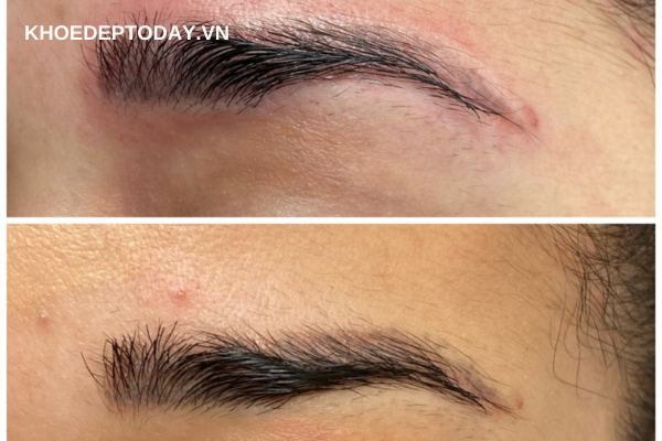 xóa xăm lông mày bằng laser là gì?