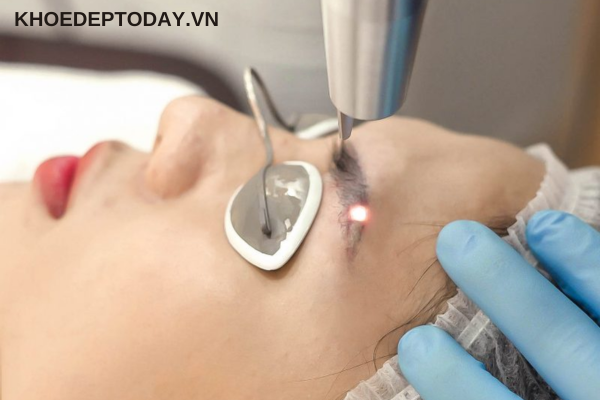 Xóa bằng công nghệ laser