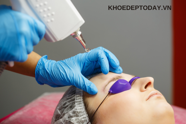 Lưu ý khi xóa lông mày trổ xanh