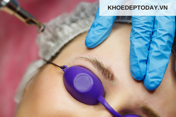 Xóa chân mày bằng laser là gì?