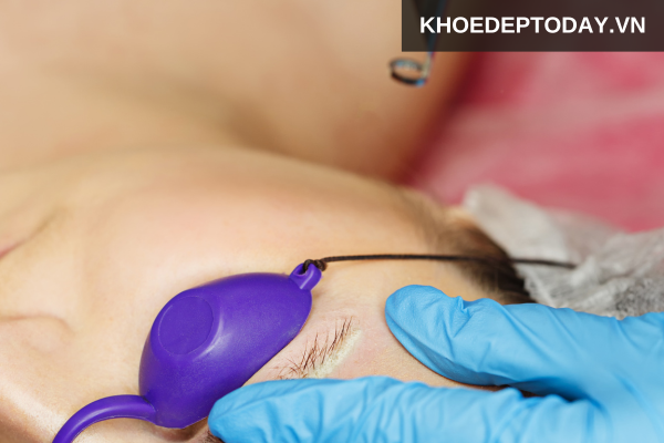 Xóa xăm bằng laser