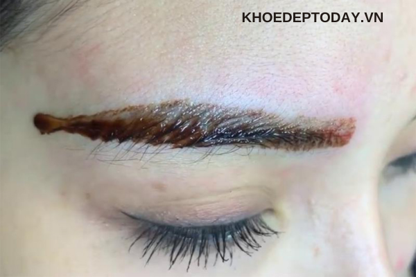 Ưu nhược điểm của phương pháp xóa lông mày bằng dung dịch