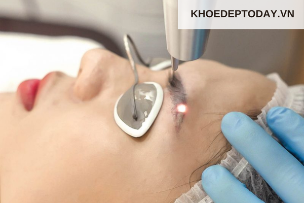 Xoá chân mày phun có hết không?